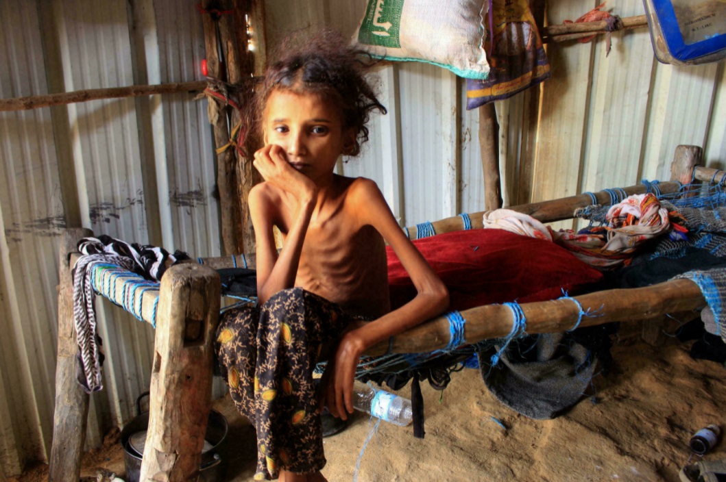 طفلة يمنية تعاني من سوء التغذية في مخيم للنازحين في حجة شمال اليمن في 23 كانون الثاني/يناير 2021 عيسى أحمد ا ف ب/ا ف ب